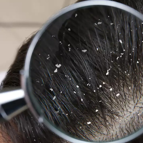 Foto di una lente d'ingrandimento che mostra la forfora nei capelli